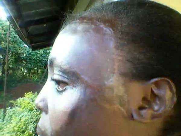 Appeal: Help Kenyan girl travel to US for reconstructive surgery