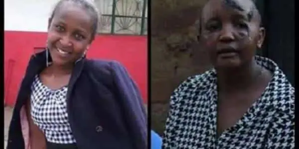 Jackline Mwende Gets Prosthetic Hands in South Korea