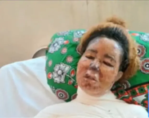 Kenyan woman Fights for her life after boyfriend scalds her